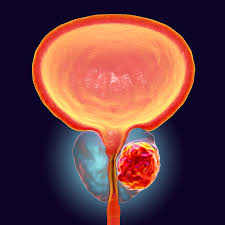 prostate cancer diagnosis and treatment